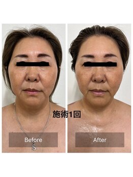 コリオ(KoRiO)/リフトアップ1回［狭山ヶ丘］