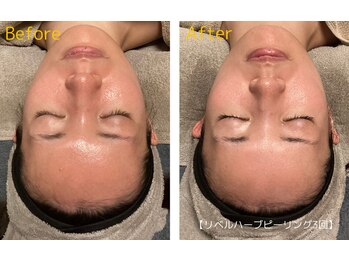 ロイヤリティ(ROYALTY)/毛穴/赤ら顔/肌のザラつき