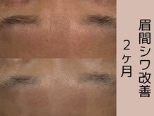 ベアール(beal)/効果No.1たるみシワケア2ヶ月