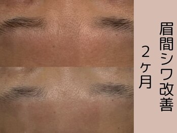 ベアール(beal)/効果No.1たるみシワケア2ヶ月