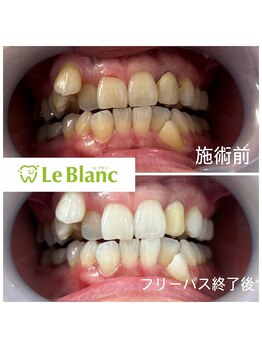 ルブラン 奈良店(Le Blanc)/3週間で白い歯を！