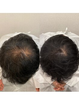 エスクリア 梅田北新地店(S.CLEAR)/抜け毛・頭皮改善