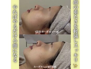 ハニエル(Haniel)/カーボキシー症例