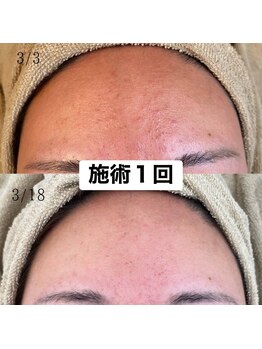 リュクスルーム(Luxe room)/30代:韓国式ハーブピーリング1回