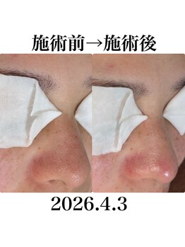 ミローズ(MIROSE)/【初回)Before→After