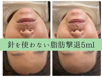 ソルニスデュオ(Solnis.-duo-)/小顔/酵素浴/ハイパーナイフEX2