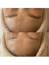 ウルス(ulus)/アンストレス＋ポレーション導入