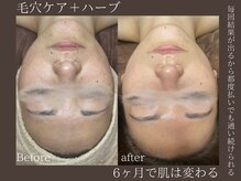 クロシェの雰囲気（ハーブピーリング/肌質改善/毛穴ケア/毛穴洗浄以上の効果/毛穴）