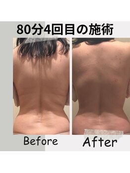 ソワンドメイ 四谷(SOIN DE MEI)/インディバダイエットモニター