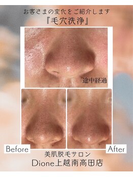 ディオーネ 上越南高田店(Dione)/毛穴洗浄&毛穴吸引