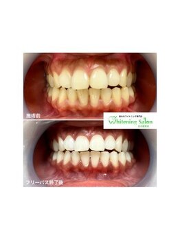ホワイトニングサロン 名古屋駅店/【ホワイトニング施術例】