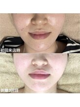 エミルカ 鹿児島店(EMILUCA)/ハーブピーリング