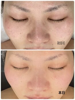 ウルト アルティメイトスキン(ULT ultimate skin)/ハイドラ認定サロン!