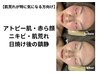 【赤み・痒み・ニキビ・肌荒れの方向け】小顔マッサージ付◎￥12000→￥6600