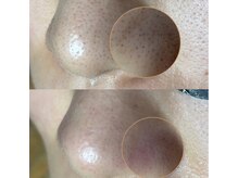 エヌ ドット ジュウイチ(N.11)/黒ずみ毛穴洗浄