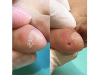 巻き爪補正店 川崎駅前店/副爪ケア