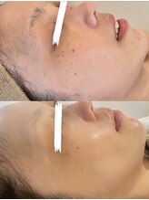 ホワイトアクア 中目黒店(WHITE AQUA)/ララピール4回経過