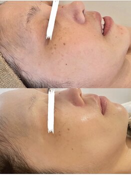 ホワイトアクア 中目黒店(WHITE AQUA)/ララピール4回経過