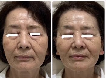 アリガトウ サロン シンパシー(A.Salon Sympathy)/ヒアルロン酸コラーゲン真皮導入