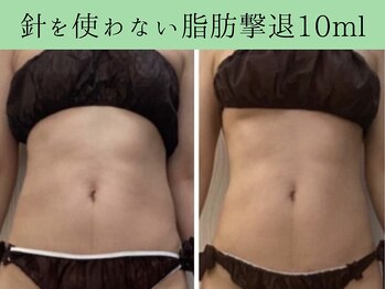 ソルニス(Solnis.)/痩身☆脂肪分解/ハイパーナイフ