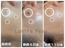 ルミラポー(Lumira Peau)