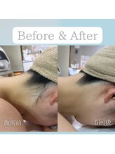 ニコ(Nico)/うなじ脱毛