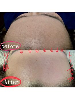 ジェルメ(Germer)/眉、額糸脱毛