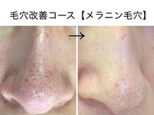 ベアトリーチェ 五反田(Beatrice)/【毛穴改善コース】メラニン毛穴