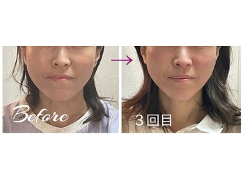 香恋/気持ちいい小顔矯正の驚きの結果