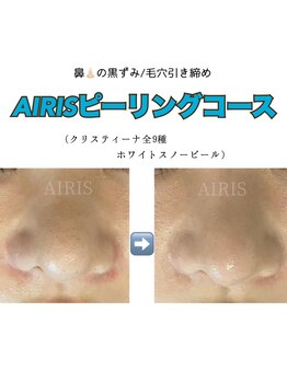 アイリス(AIRIS)/黒ずみ撃退!