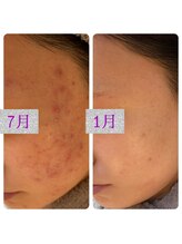 ルシアス(LUCIAS)/ハーブピーリングでニキビケア