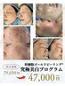 【限定割】究極美白プログラム |肌質改善 幹細胞ゴールドピーリング