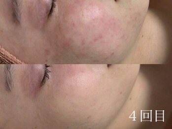 ホワイトアクア 鹿児島店(WHITE AQUA)/ハーブピーリング/肌質改善/荒田