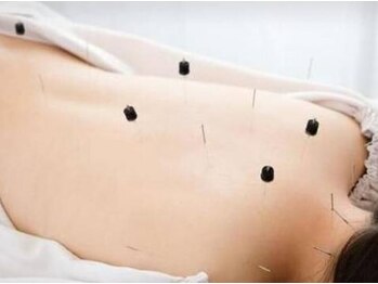 アキュリラ(Acurela)の写真/大事なのは深層筋と骨盤のケア◆全身鍼灸と骨盤矯正で慢性的な肩こり・腰痛・頭痛・自律神経不調を根本改善