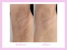 キワミビューティ(KIWAMI BEAUTY)/ローマピンク　脇　症例