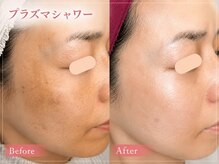 ハナ(HANA)の雰囲気（プラズマシャワーでシミ、シワ、くすみが緩和されました◎）