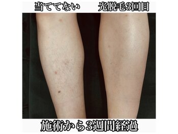 サロンド ユニバース(salon de universe)/メンズ脱毛★