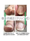 フック(クリップ)式巻き爪矯正