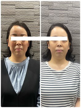 長寿鍼灸院 長寿整骨院/ハリネズミ女優美容鍼効果★