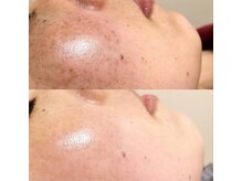 シャルム エスボーテ(charme Esbeaute)/ヒト幹細胞トリートメント