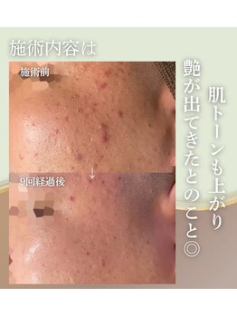 ハーブのほし/長年繰り返すニキビケア