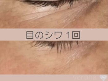 ベアール(beal)/たるみシワケア1回