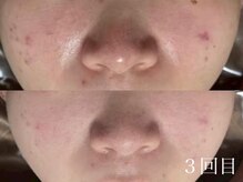 ホワイトアクア 鹿児島店(WHITE AQUA)/ハーブピーリング/荒田/鹿児島