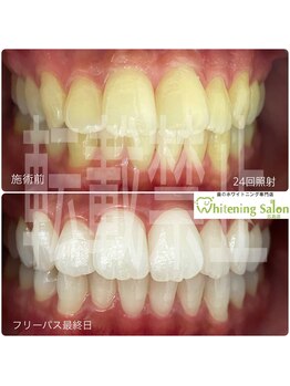 ホワイトニングサロン 広島店/【ホワイトニング施術例】