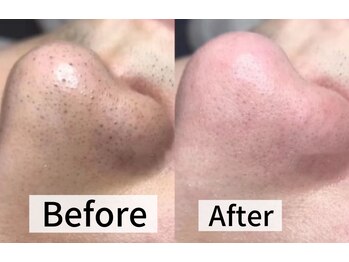 ルミナエステ(LUMINA ESTH)/毛穴/毛穴洗浄/毛穴ケア|症例