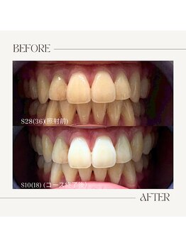 ホワイトニングビューティー 鯖江店(WHITENING BEAUTY)/１ヶ月お試しホワイトニング