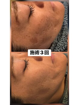 リュクスルーム(Luxe room)/韓国式ハーブピーリング３回