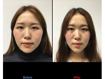 整体カワハラ(KAWAHARA)/小顔整体3回目ビフォーアフター