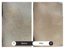 リジュ(Reje)/ 背中ケア