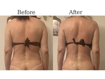 グランディール(GRANDIR)/【痩身】上半身コース8回